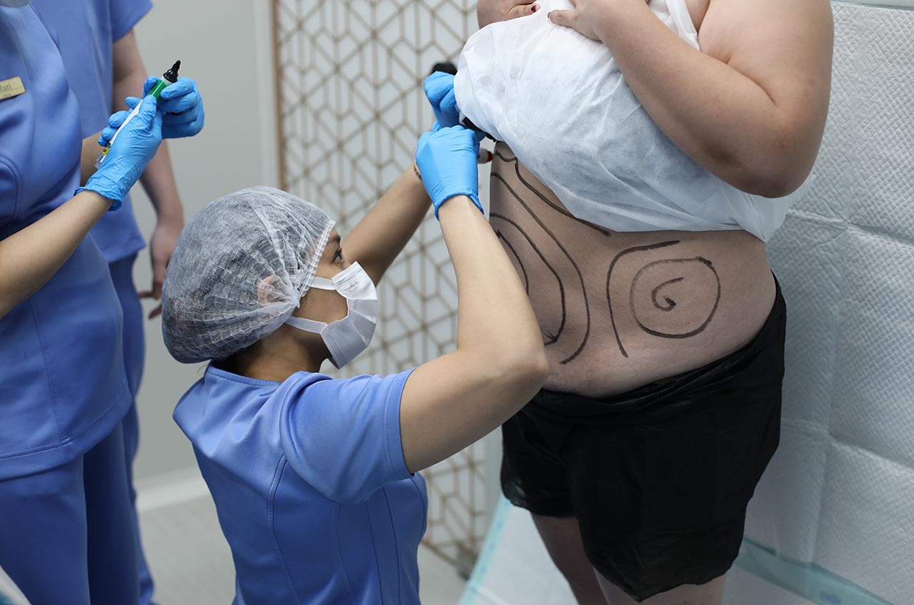 Sebelum tindakan dimulai, dokter melakukan body marking untuk memastikan area lemak yang akan dikoreksi sesuai rencana dan kebutuhan setiap pasien.